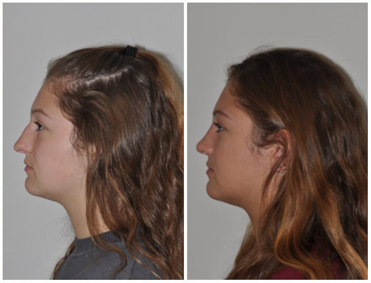 Rhinoplasty Before & After Gallery - Patient 382481 - Image 3