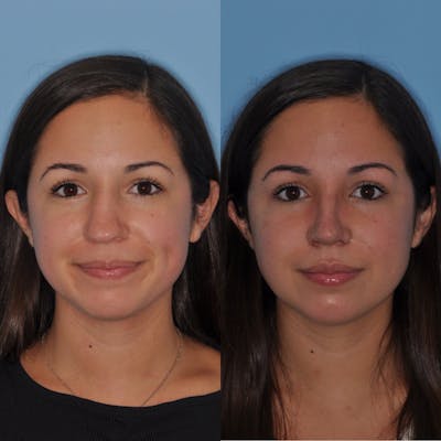 Rhinoplasty Before & After Gallery - Patient 557673 - Image 1