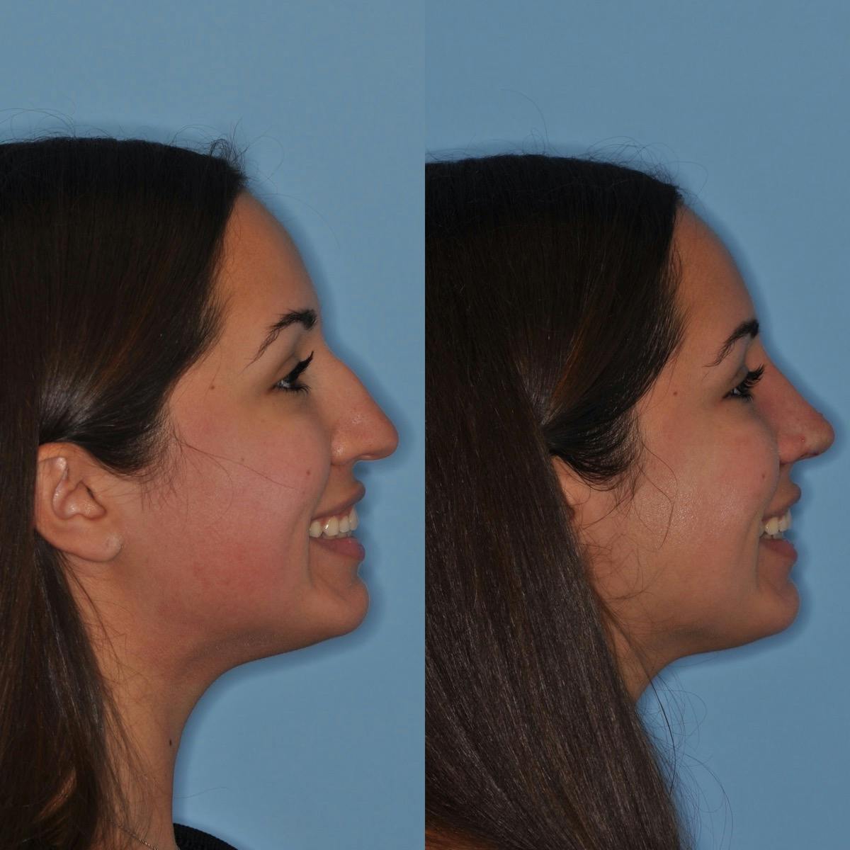 Rhinoplasty Before & After Gallery - Patient 557673 - Image 2