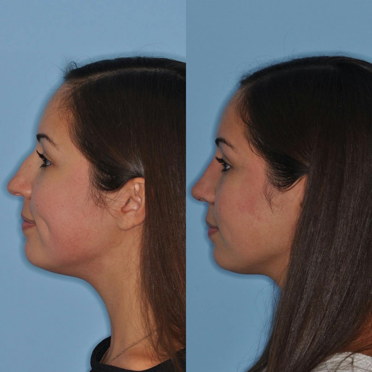 Rhinoplasty Before & After Gallery - Patient 557673 - Image 3