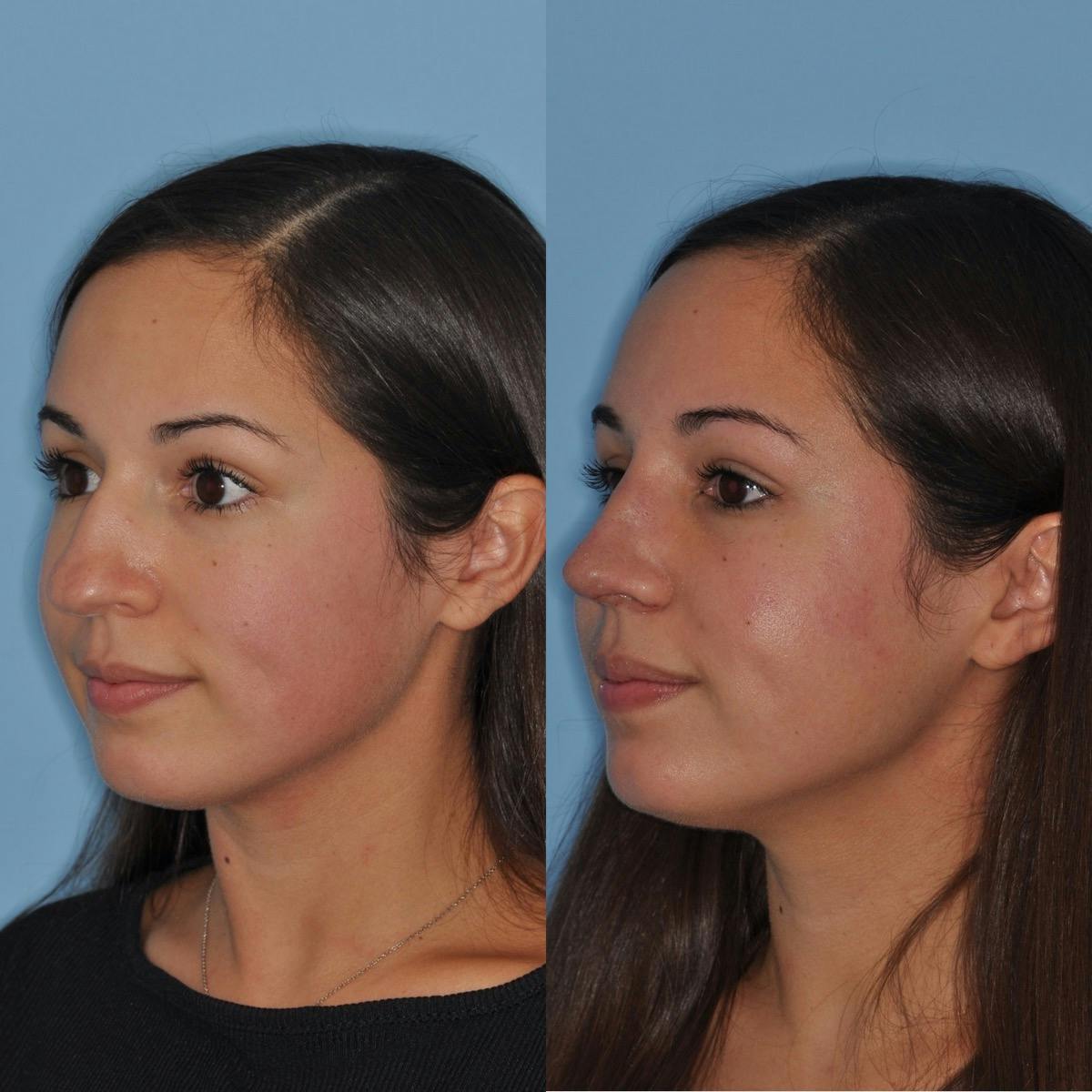 Rhinoplasty Before & After Gallery - Patient 557673 - Image 5