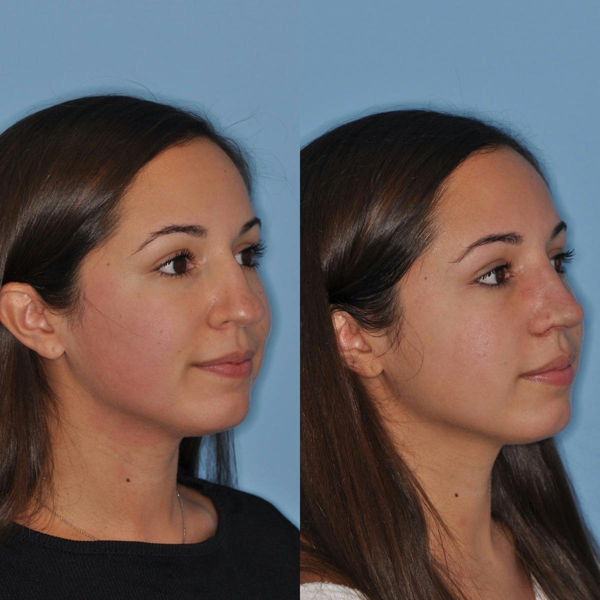 Rhinoplasty Before & After Gallery - Patient 557673 - Image 6