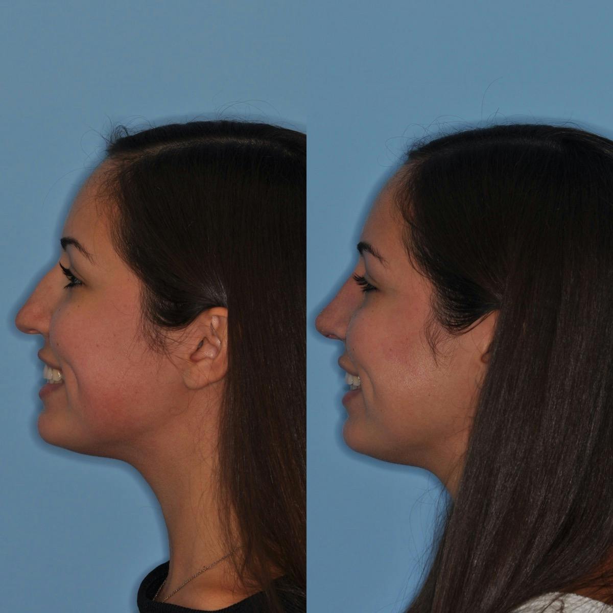 Rhinoplasty Before & After Gallery - Patient 557673 - Image 7