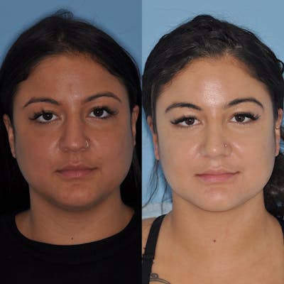 Rhinoplasty Before & After Gallery - Patient 123792 - Image 1