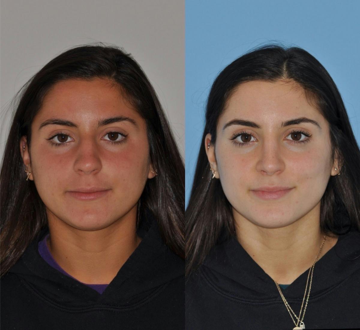 Rhinoplasty Before & After Gallery - Patient 113391 - Image 1