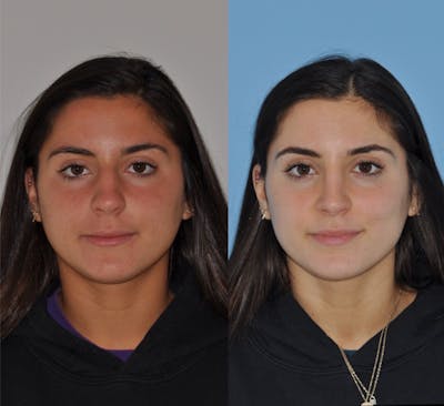 Rhinoplasty Before & After Gallery - Patient 113391 - Image 1