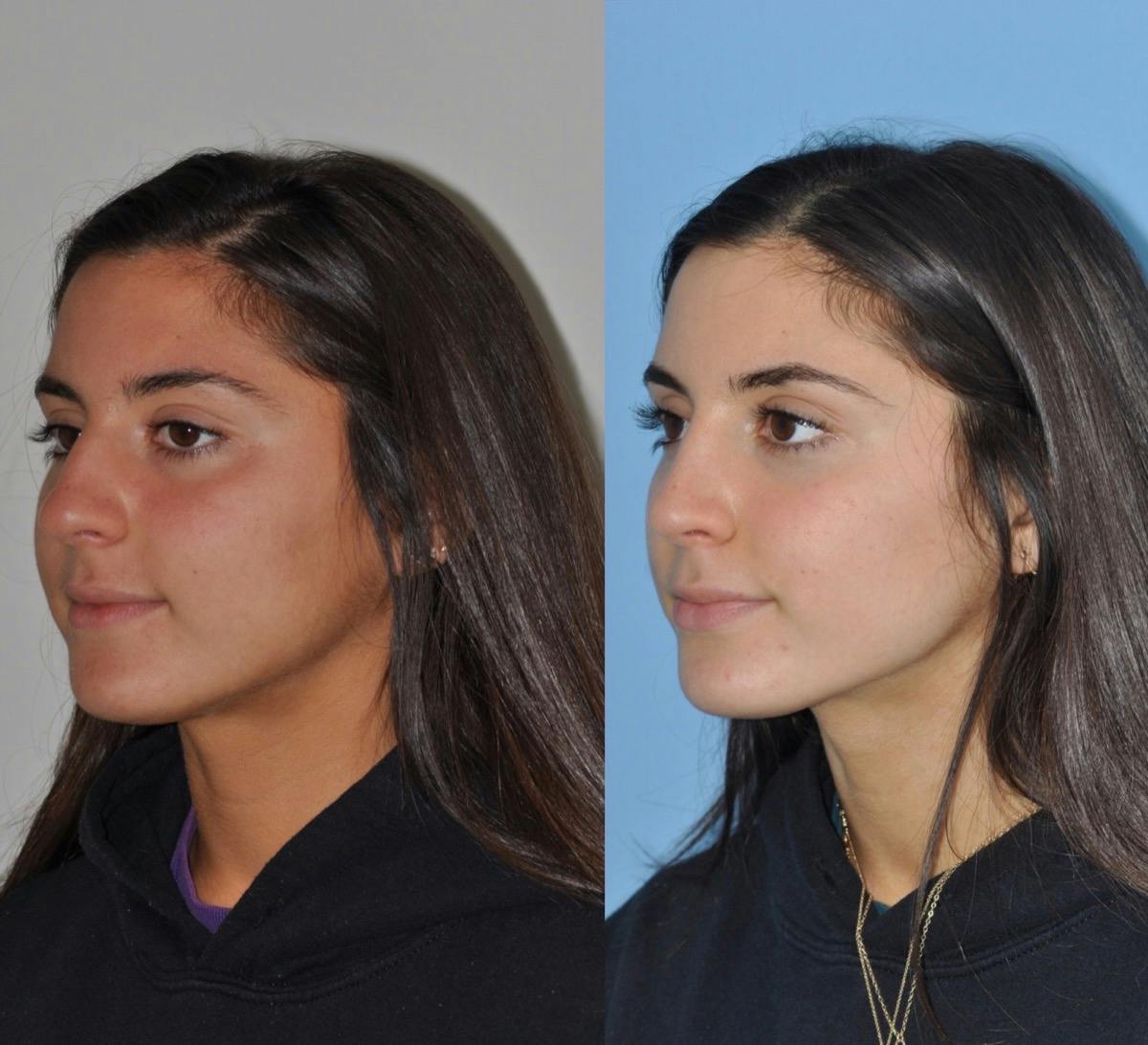 Rhinoplasty Before & After Gallery - Patient 113391 - Image 2