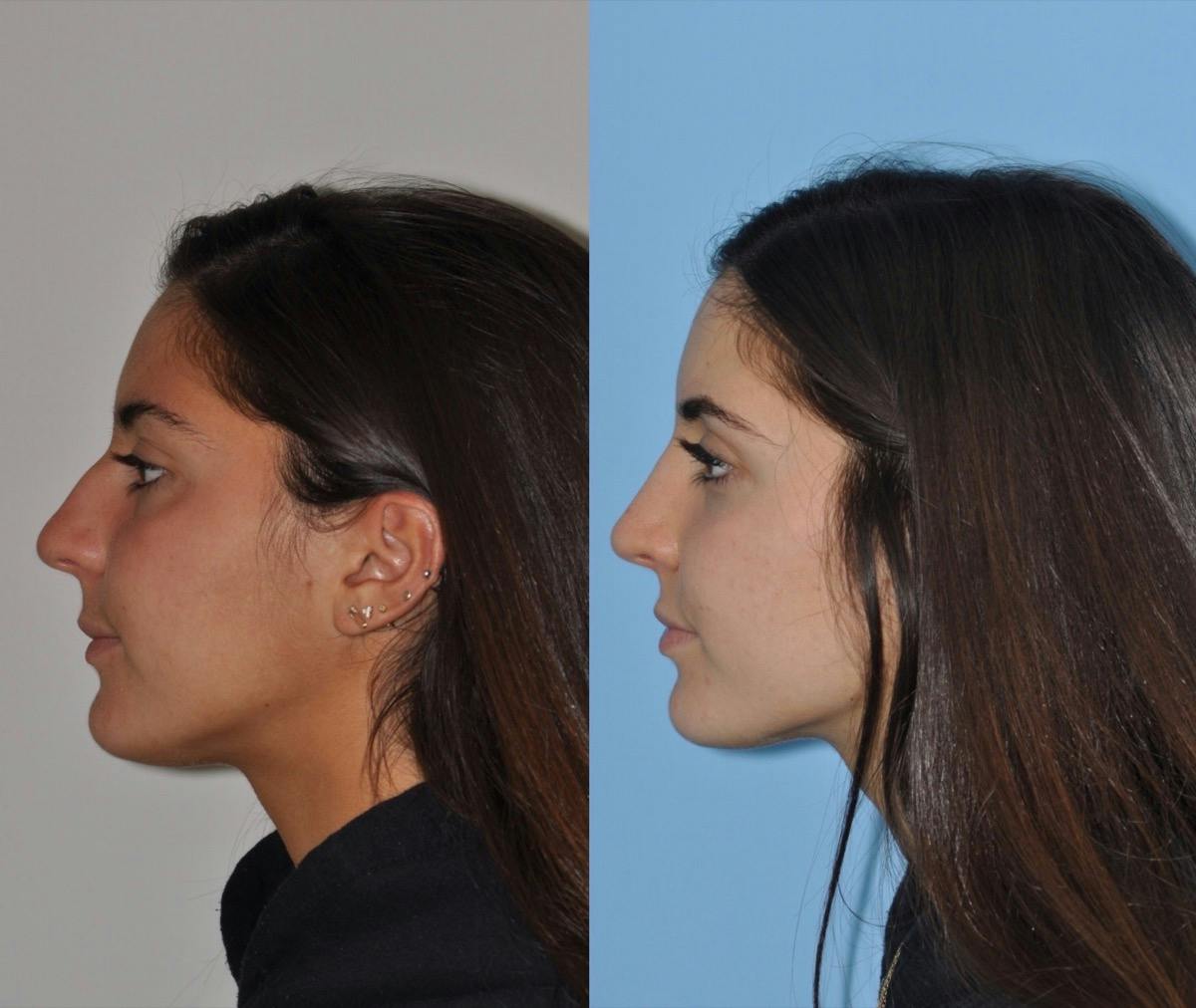 Rhinoplasty Before & After Gallery - Patient 113391 - Image 3