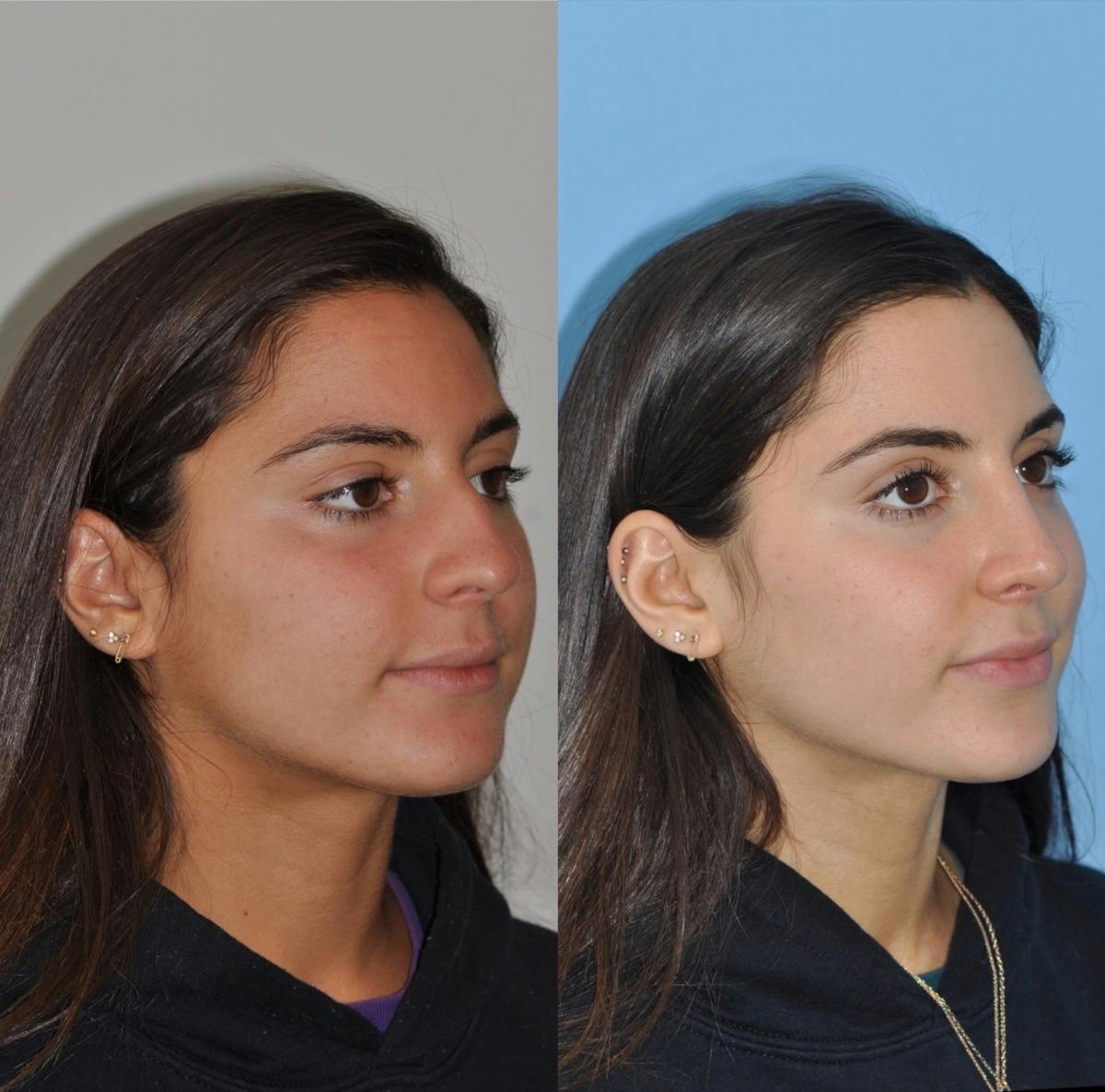 Rhinoplasty Before & After Gallery - Patient 113391 - Image 4
