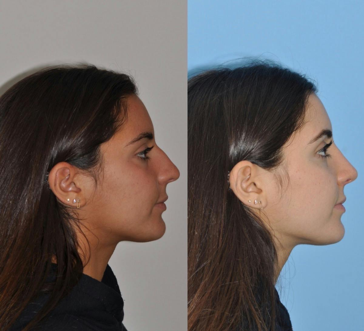 Rhinoplasty Before & After Gallery - Patient 113391 - Image 5