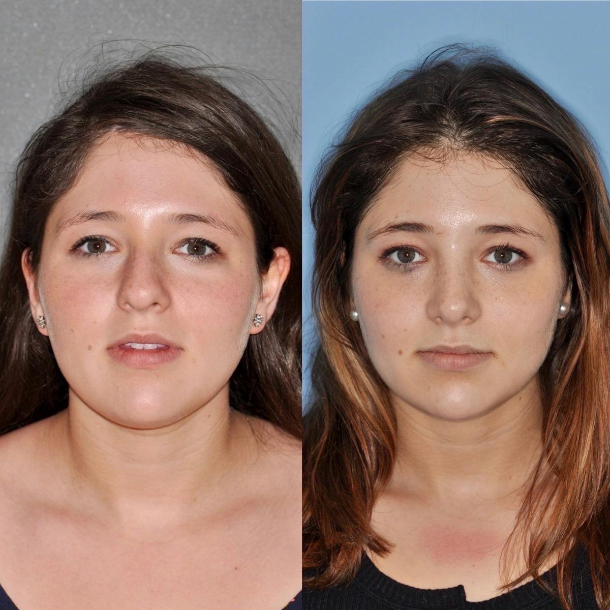 Rhinoplasty Before & After Gallery - Patient 248069 - Image 1