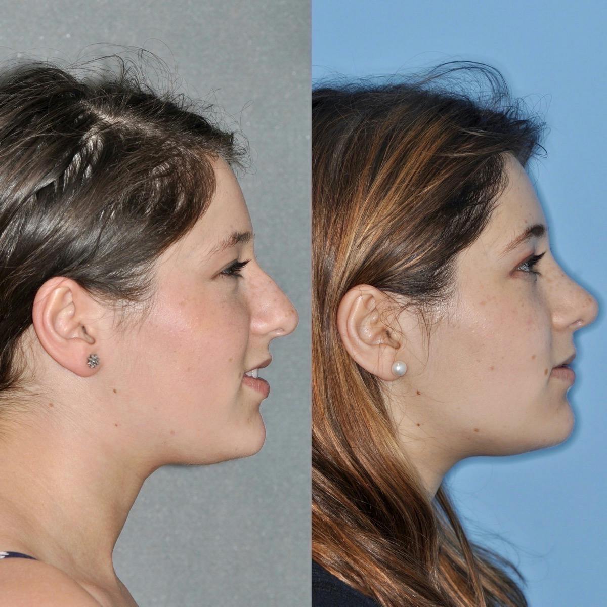 Rhinoplasty Before & After Gallery - Patient 248069 - Image 2