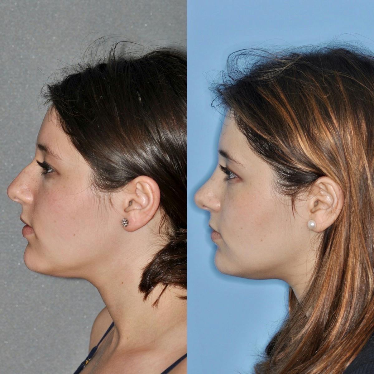 Rhinoplasty Before & After Gallery - Patient 248069 - Image 4