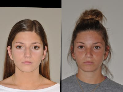 Rhinoplasty Before & After Gallery - Patient 177639 - Image 1