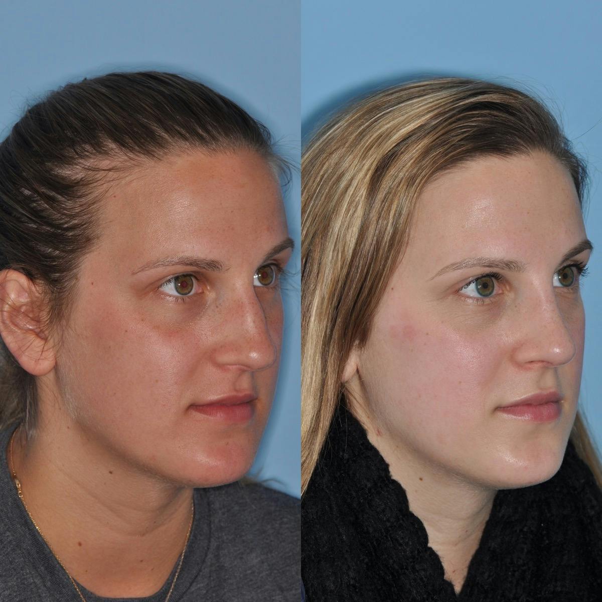 Rhinoplasty Before & After Gallery - Patient 737733 - Image 1
