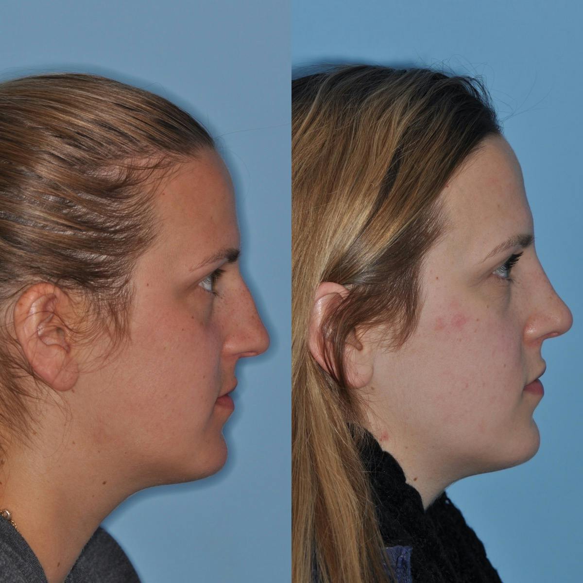 Rhinoplasty Before & After Gallery - Patient 737733 - Image 2