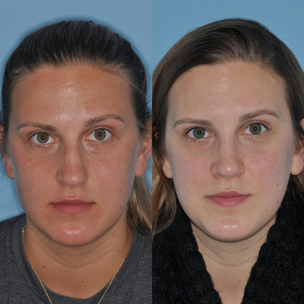 Rhinoplasty Before & After Gallery - Patient 737733 - Image 3