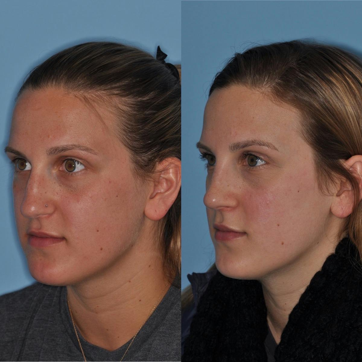 Rhinoplasty Before & After Gallery - Patient 737733 - Image 5