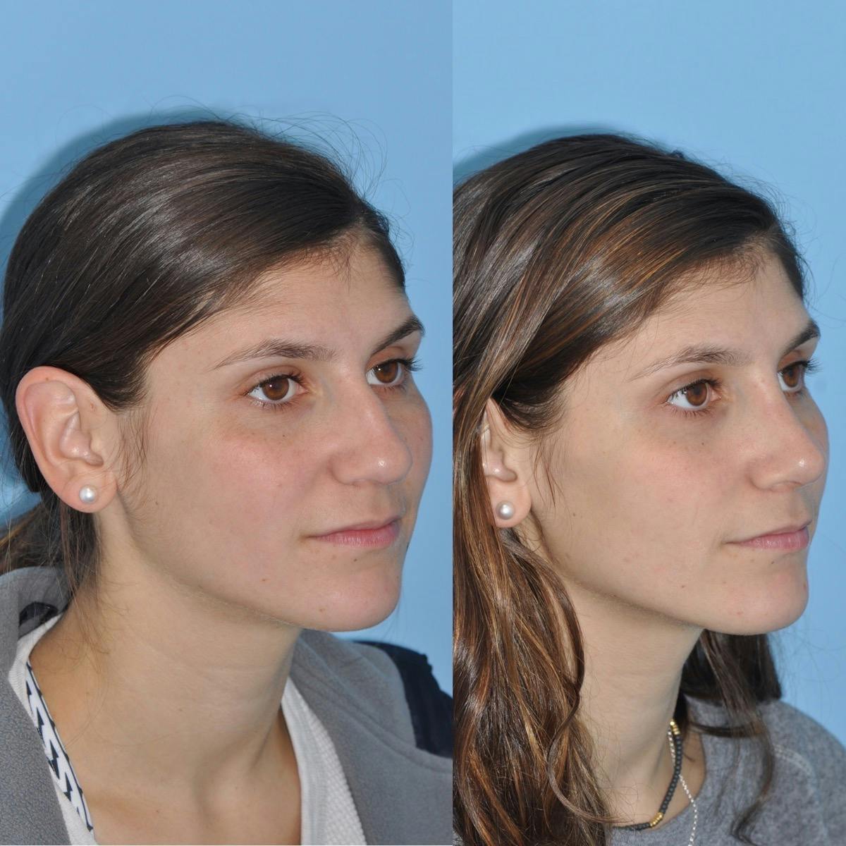 Rhinoplasty Before & After Gallery - Patient 200086 - Image 1