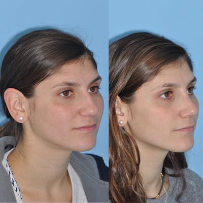Rhinoplasty Before & After Gallery - Patient 200086 - Image 1