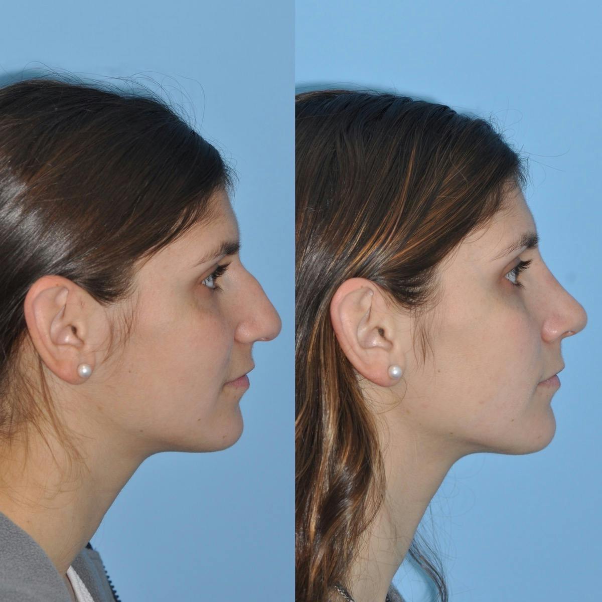 Rhinoplasty Before & After Gallery - Patient 200086 - Image 2