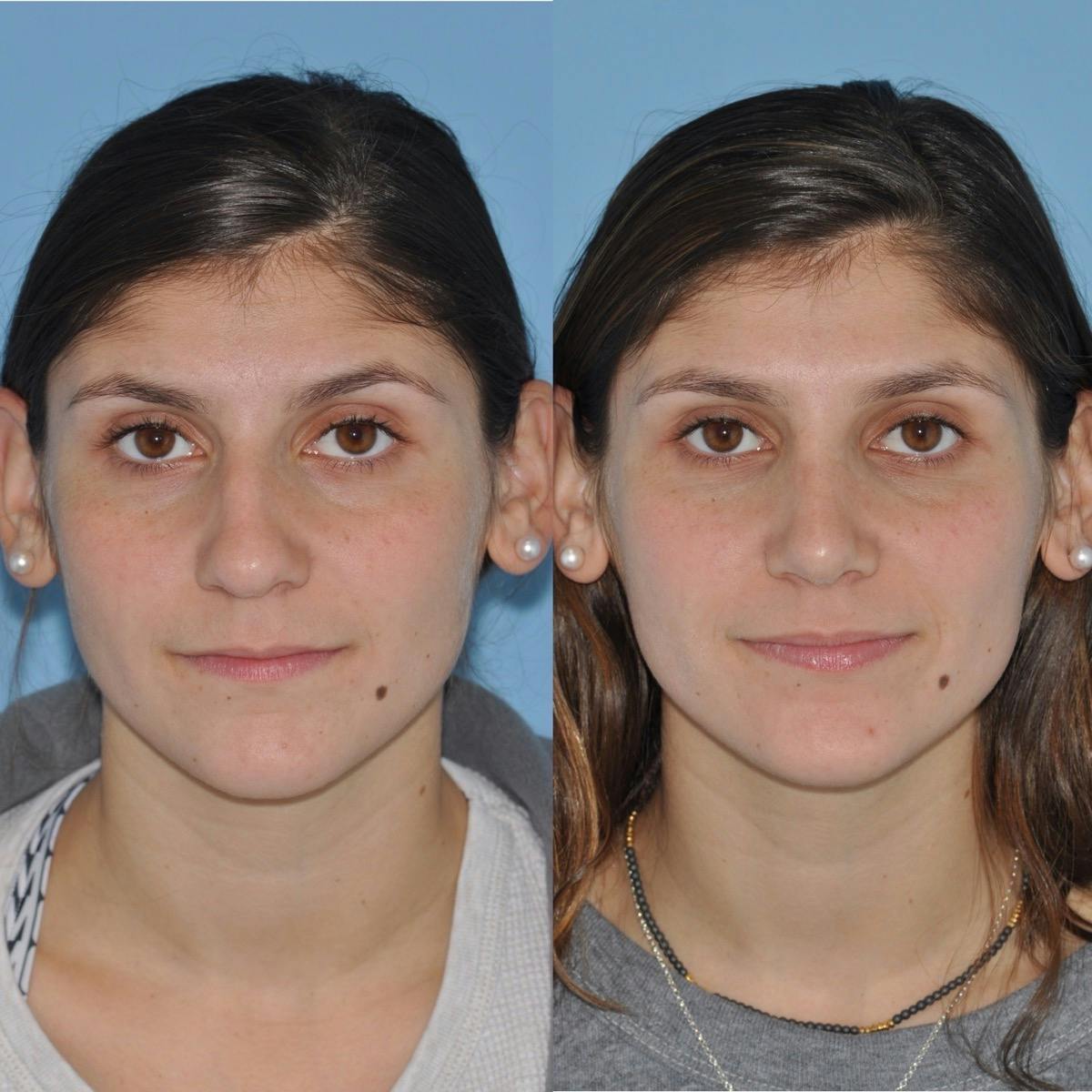 Rhinoplasty Before & After Gallery - Patient 200086 - Image 3