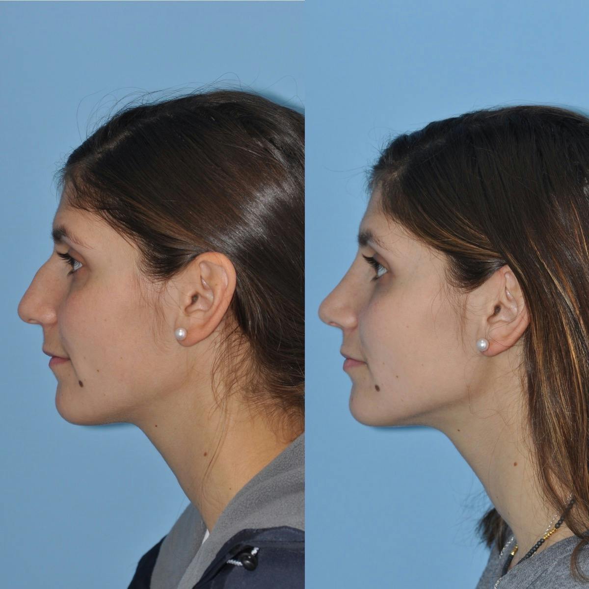 Rhinoplasty Before & After Gallery - Patient 200086 - Image 4
