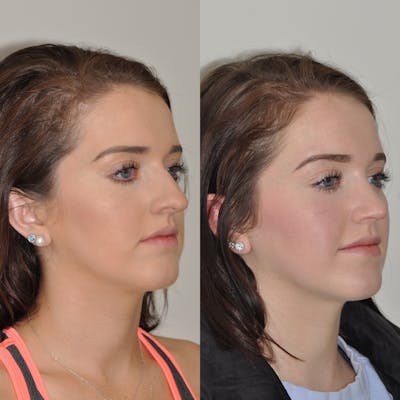 Rhinoplasty Before & After Gallery - Patient 115507 - Image 1