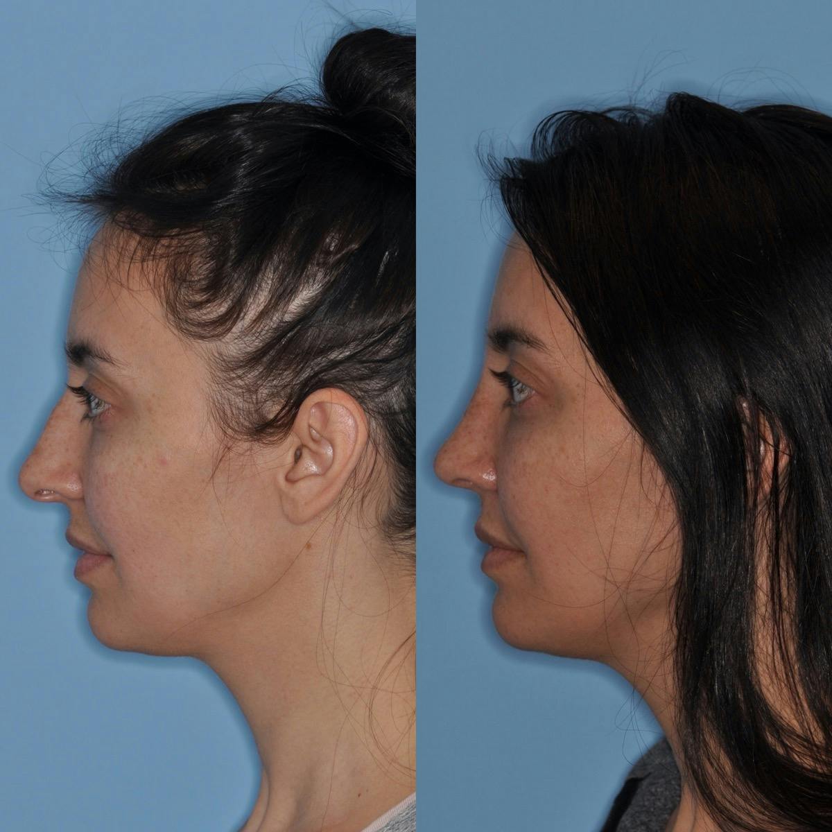 Rhinoplasty Before & After Gallery - Patient 355666 - Image 2