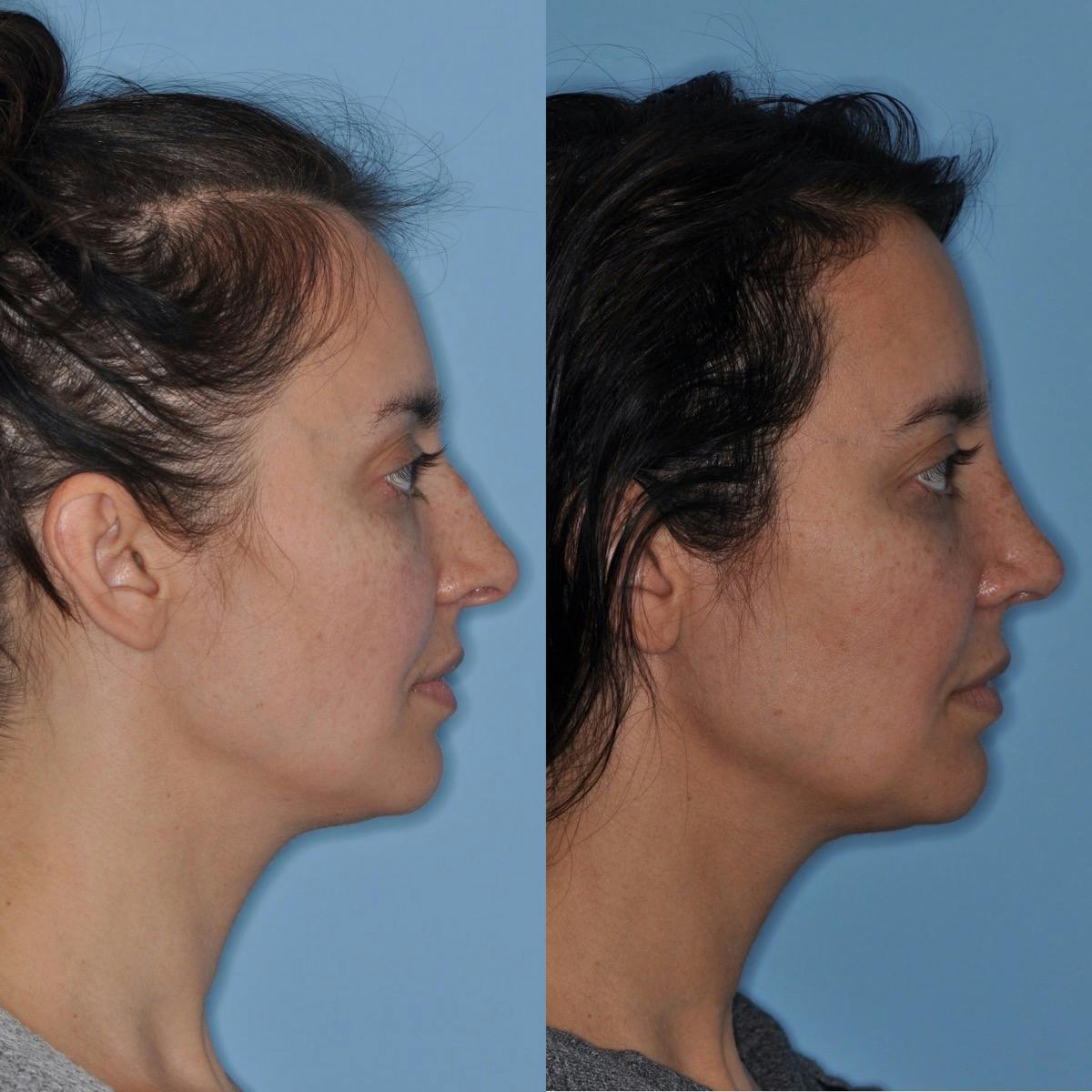 Rhinoplasty Before & After Gallery - Patient 355666 - Image 3
