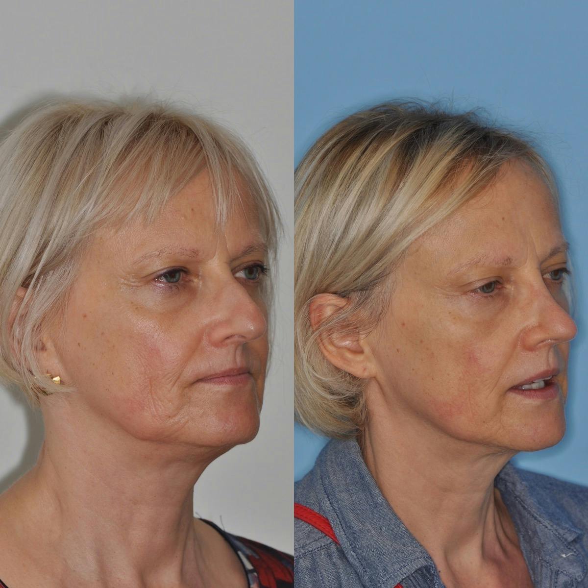 Rhinoplasty Before & After Gallery - Patient 100223 - Image 1