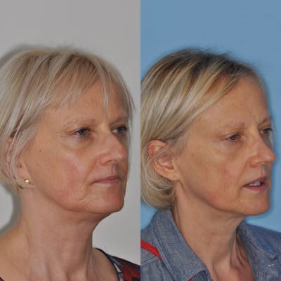 Rhinoplasty Before & After Gallery - Patient 100223 - Image 1