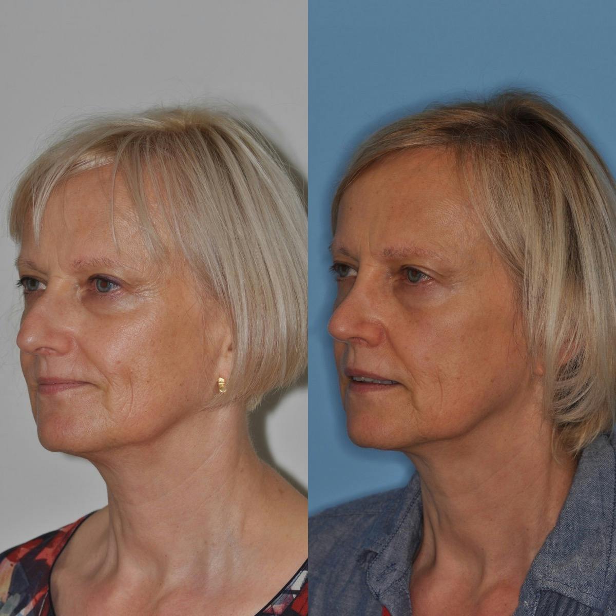 Rhinoplasty Before & After Gallery - Patient 100223 - Image 2