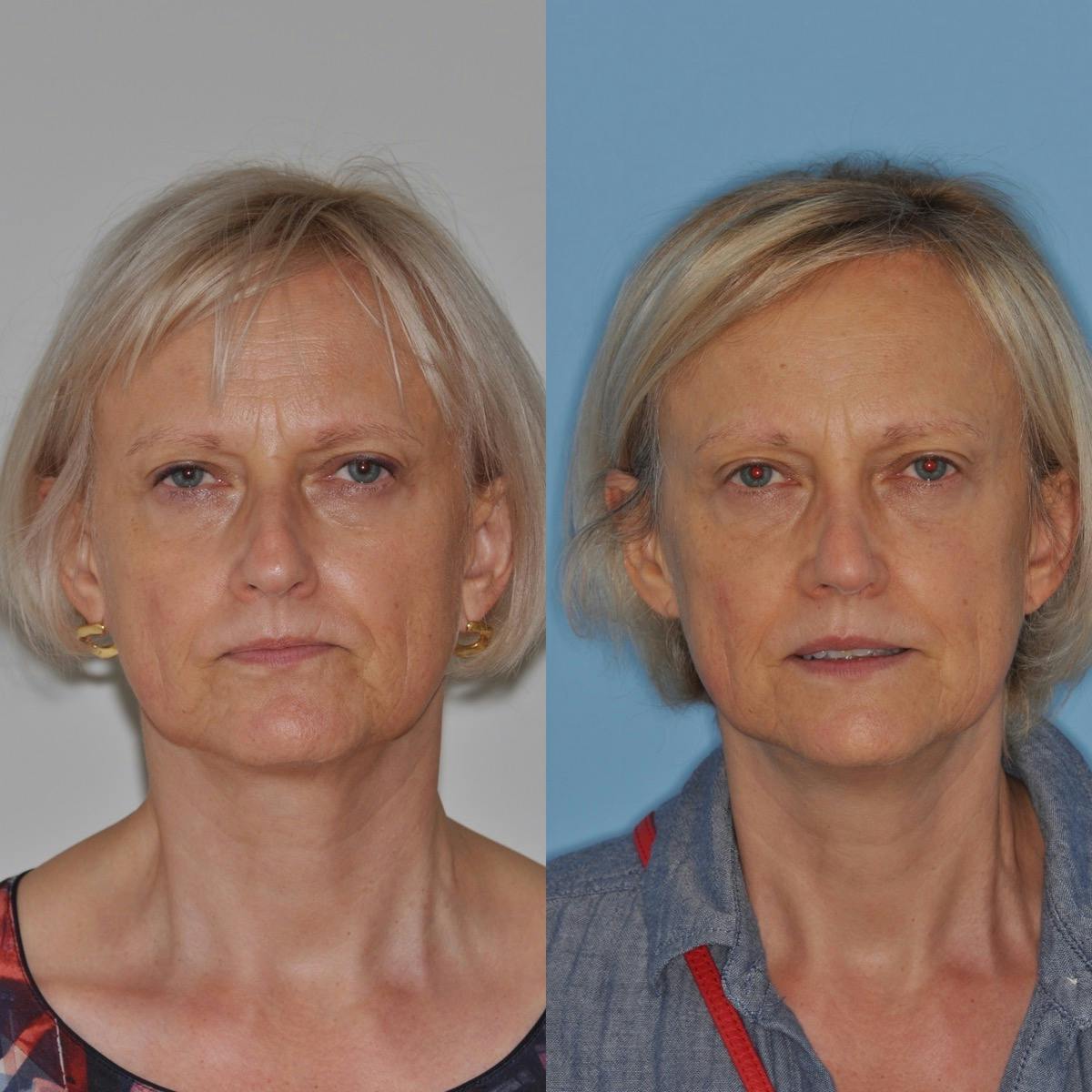 Rhinoplasty Before & After Gallery - Patient 100223 - Image 3