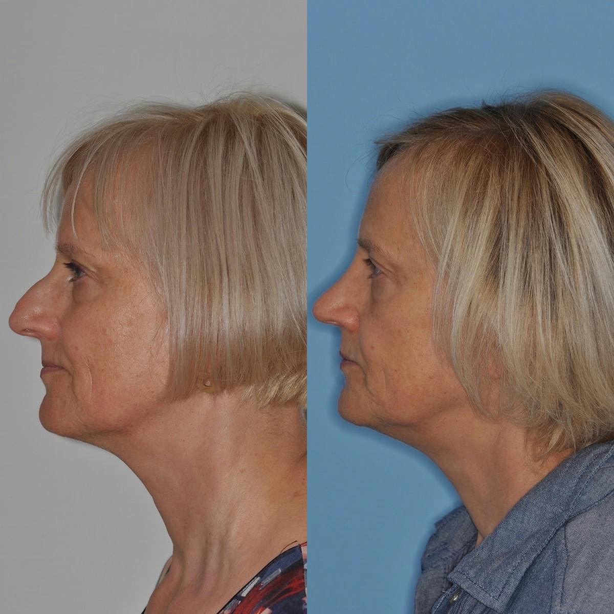 Rhinoplasty Before & After Gallery - Patient 100223 - Image 4