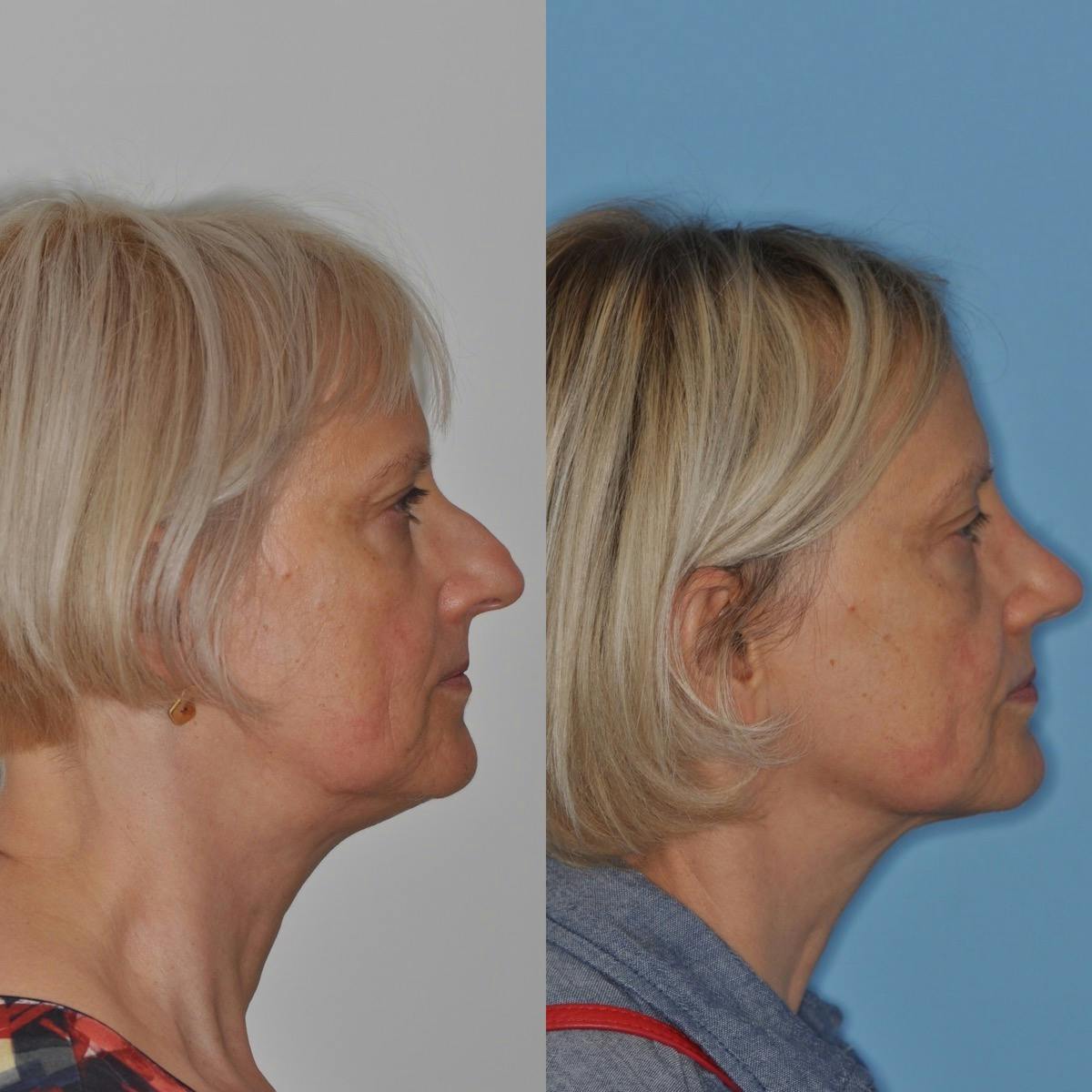 Rhinoplasty Before & After Gallery - Patient 100223 - Image 5