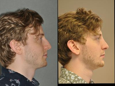 Rhinoplasty Before & After Gallery - Patient 299596 - Image 1
