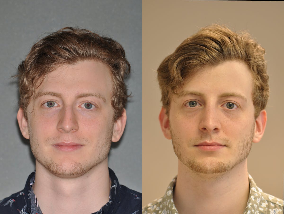Rhinoplasty Before & After Gallery - Patient 299596 - Image 2
