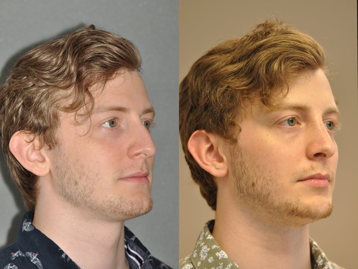 Rhinoplasty Before & After Gallery - Patient 299596 - Image 3