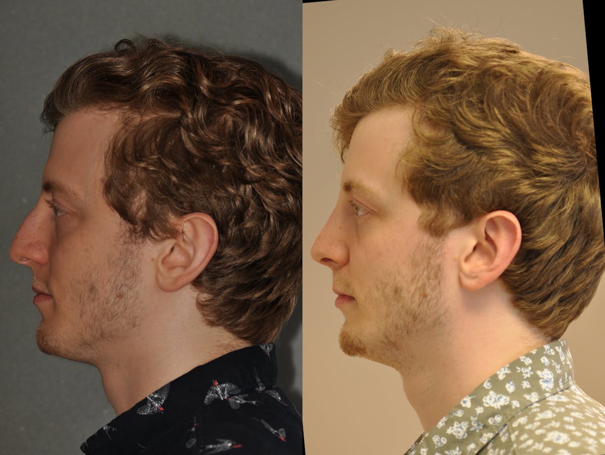 Rhinoplasty Before & After Gallery - Patient 299596 - Image 4