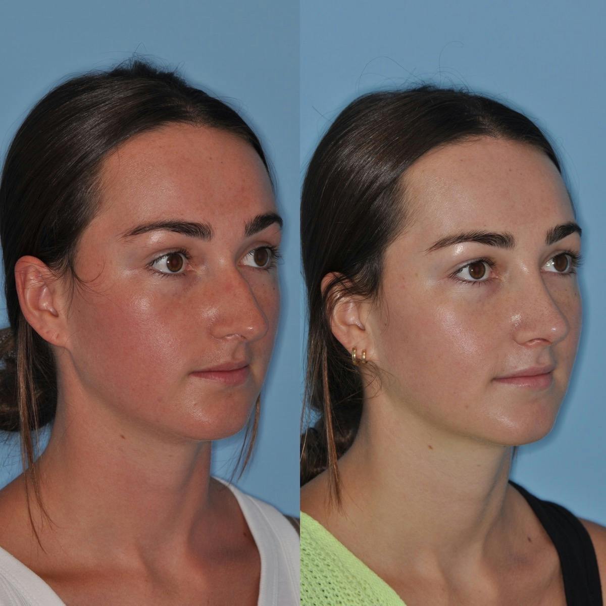 Rhinoplasty Before & After Gallery - Patient 219420 - Image 1
