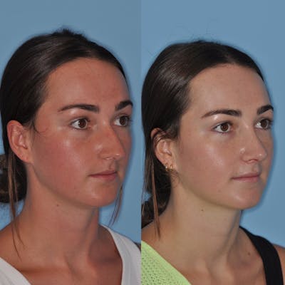 Rhinoplasty Before & After Gallery - Patient 219420 - Image 1