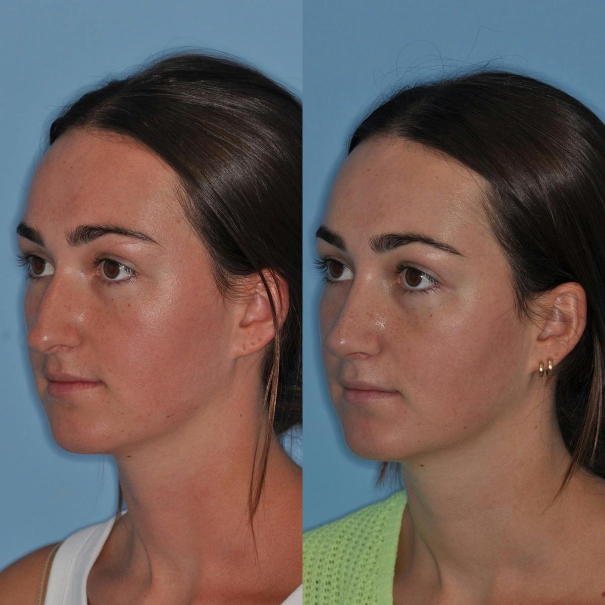 Rhinoplasty Before & After Gallery - Patient 219420 - Image 2