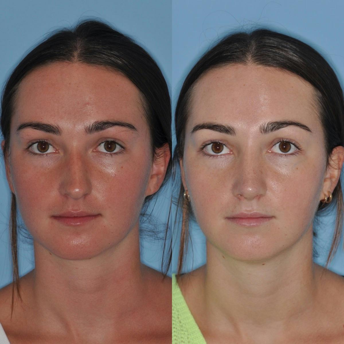 Rhinoplasty Before & After Gallery - Patient 219420 - Image 5
