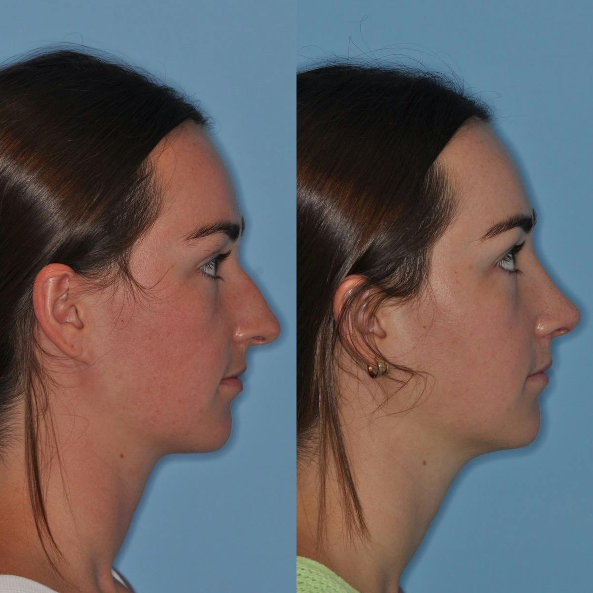 Rhinoplasty Before & After Gallery - Patient 219420 - Image 6