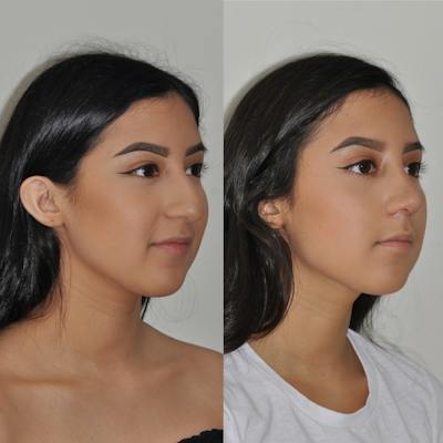 Rhinoplasty Before & After Gallery - Patient 114095 - Image 1