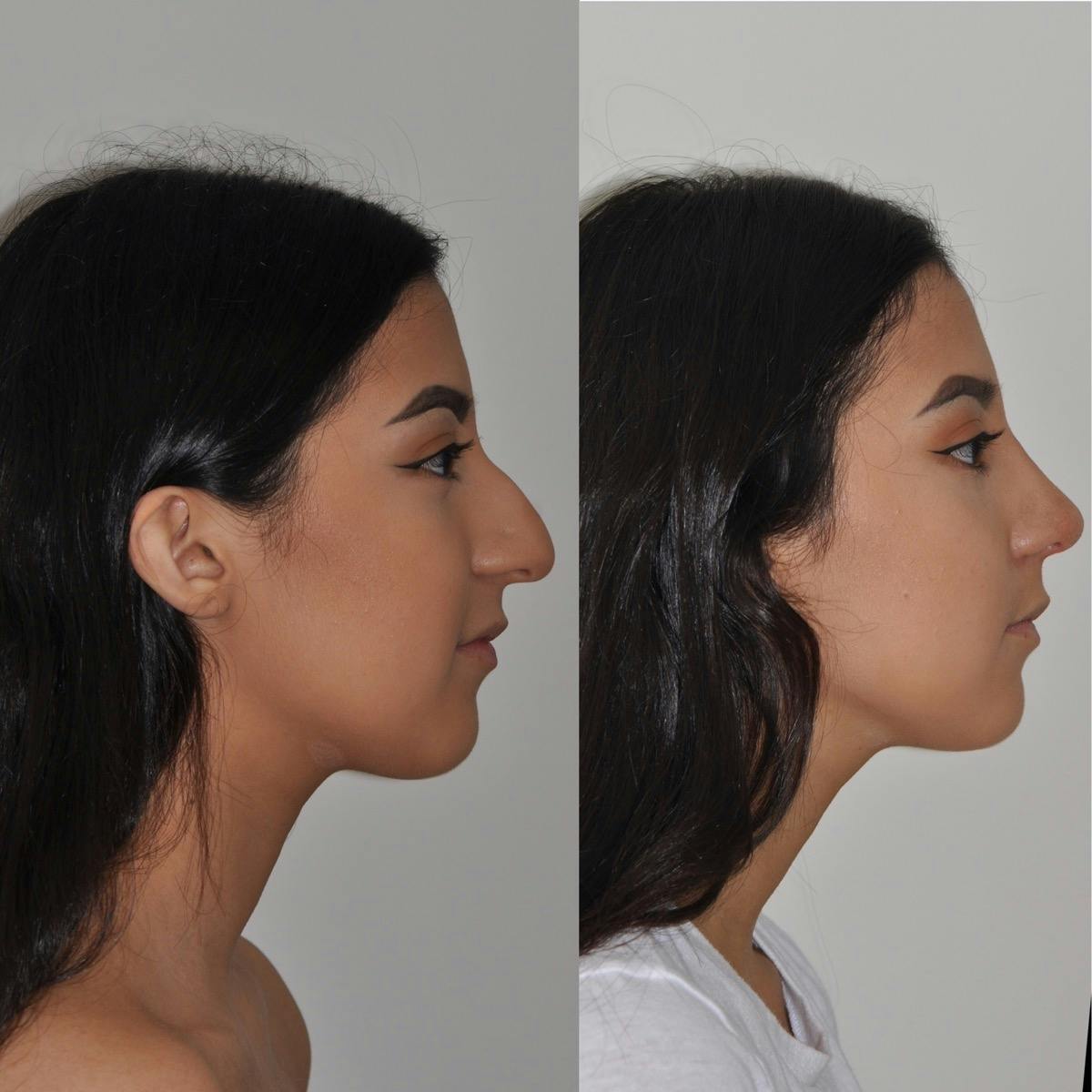 Rhinoplasty Before & After Gallery - Patient 114095 - Image 2