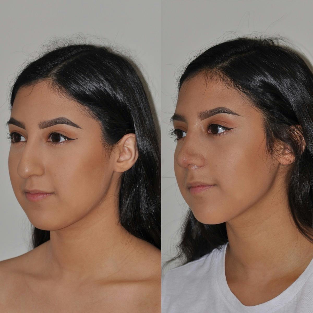 Rhinoplasty Before & After Gallery - Patient 114095 - Image 3