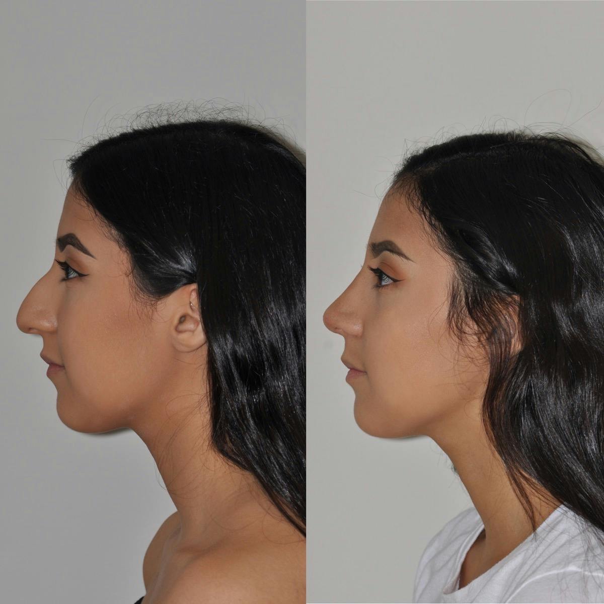 Rhinoplasty Before & After Gallery - Patient 114095 - Image 4