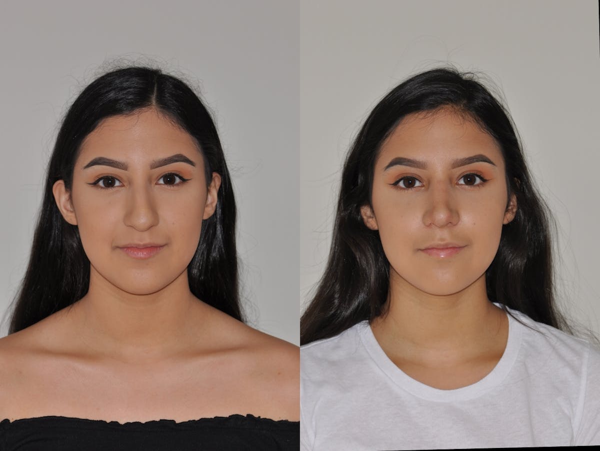 Rhinoplasty Before & After Gallery - Patient 114095 - Image 5